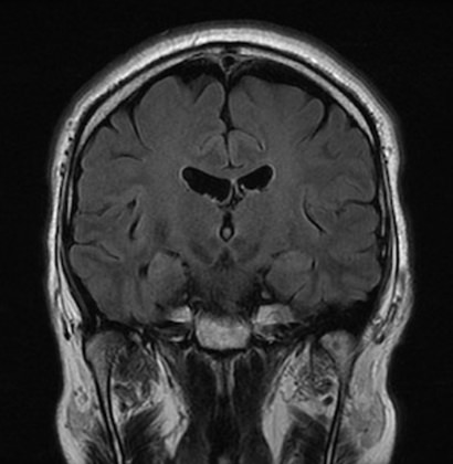 正常MRI