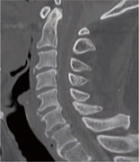 頚椎CT側面像術前