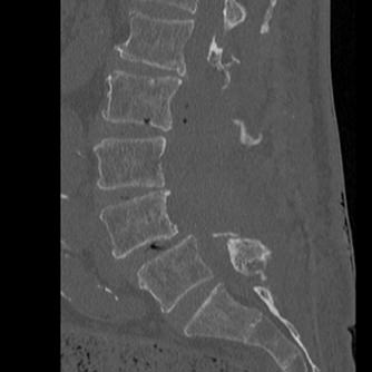 術後腰椎側面CT